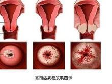 <b>怀孕后阴道出血的原因与防治</b>
