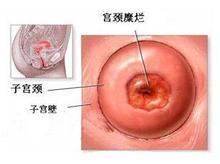 <b>引发宫颈糜烂的原因有哪些</b>