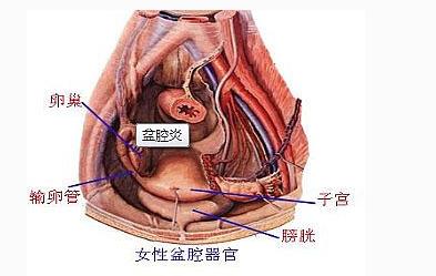 盆腔炎的出现都会有哪些严重的伤痛?