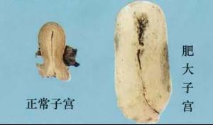 宫颈肥大主要有哪些表现