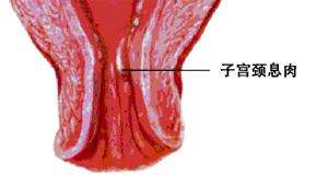 宫颈息肉是怎样形成的