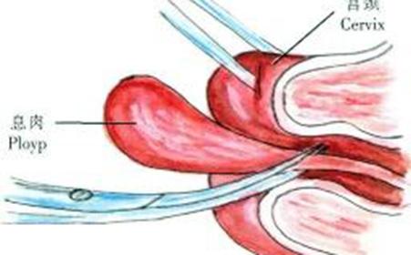 【宫颈息肉手术要住院吗】宫颈息肉手术后要休息多久？