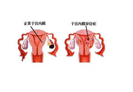 子宫内膜异位症对女性有哪些危害