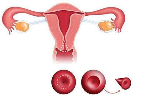 预防子宫内膜异位症的措施有哪些
