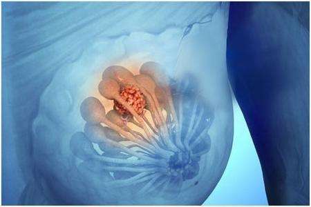乳腺纤维瘤是怎么引起的？主要由4方面所诱发
