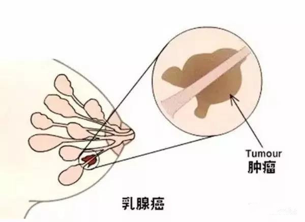 乳腺纤维瘤的诊断要点是哪些？你所不了解的疾病详情！