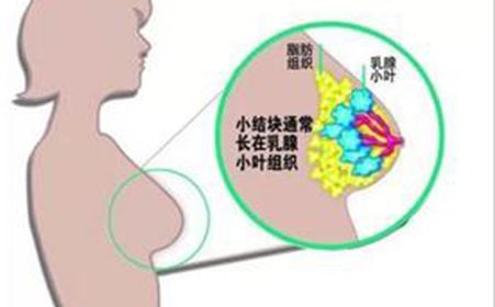 淮安乳腺增生治疗多少钱?费用解析一看明了