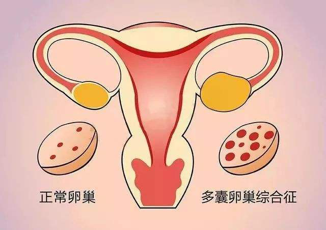 多囊卵巢综合症影响怀孕吗