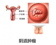 <b>阴道肿瘤是如何引起的呢</b>