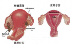 介绍卵巢囊肿的症状