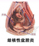 结核性盆腔炎的症状有哪些