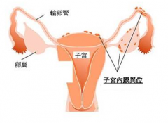 子宫内膜异位症的检查方法有哪些