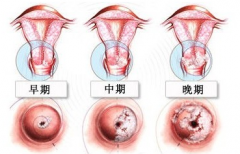 三度宫颈糜烂如何治疗