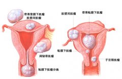 子宫肌瘤注意