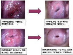 宫颈肥大会给女性带来哪些危害?