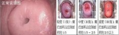 女性患上宫颈糜烂的症状