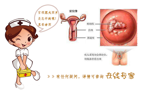 宫颈肥大常见的表现有哪些