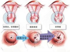 宫颈糜烂2度有什么症状吗？需要治疗吗？