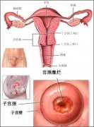 宫颈糜烂怎么引起的？如何预防宫颈糜烂