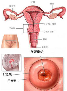 宫颈糜烂