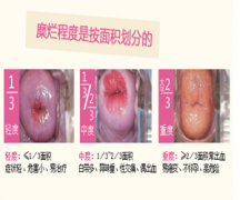 1度宫颈糜烂有多严重【详细介绍宫颈糜烂的治疗