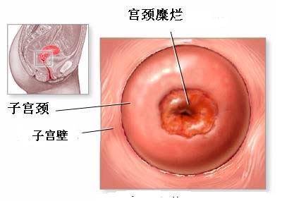 宫颈糜烂花多少钱治疗，淮安治疗糜烂的价格