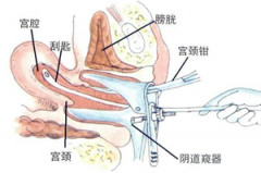 清宫疼不疼要多长时间【图】清宫疼痛可以忍受吗