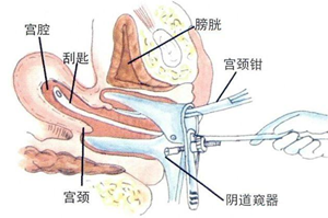 清宫疼不疼要多长时间,清宫疼痛可以忍受吗