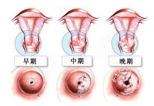 二度宫颈糜烂怎么治疗【治疗方案都在这里】