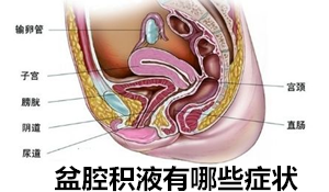 【盆腔积液有哪些症状】出现这些症状时，要小心！