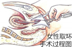 【图集】女性取环手术过程图‘拼二胎’一定要知道的事