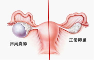 卵巢囊肿的症状，有多可怕_出现这6种症状时，要小心