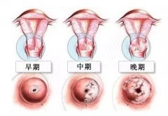 【疑问】宫颈糜烂可以自愈吗？提醒，宫颈糜烂需重视！