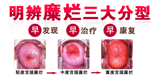 宫颈糜烂二度怎么治疗?【选对方法，少走捷径！】