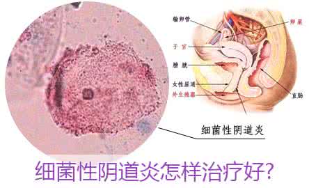 细菌性阴道炎怎么治？警惕！4种细菌性阴道炎感染途径！