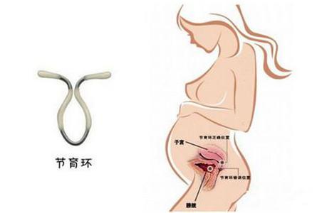 【医生讲堂】女人上环要多久换次？3种情况必须取环！