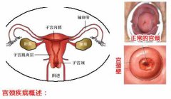 宫禁糜烂是怎么引起的？揭秘这4大罪魁因素！