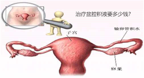 淮安治疗盆腔积液要多少钱_淮安哪家医院不乱收费？