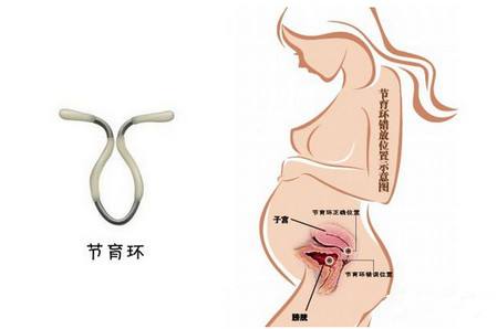 取节育环疼不疼?【健康】2个取环的术前准备！