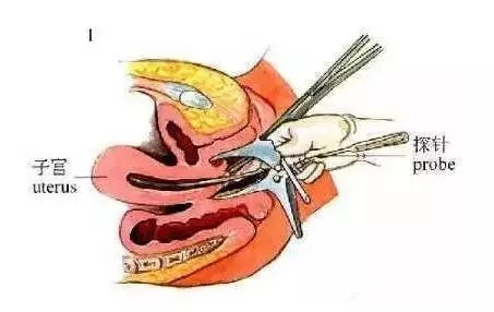 【图解】取环手术全过程_带你具体了解取环的每步骤！