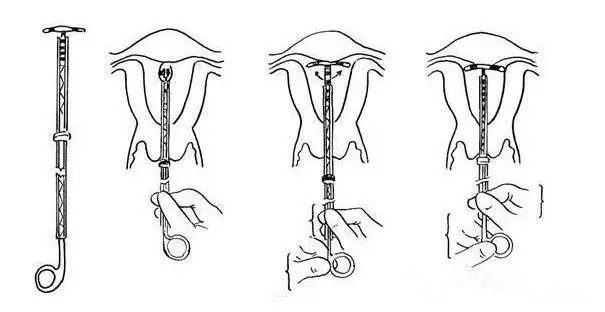 【图解】取环手术全过程_带你具体了解取环的每步骤！