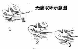 【图解】取环手术全过程_带你具体了解取环的每步骤！