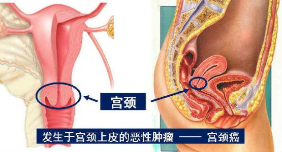 女性接触性阴道出血是什么病？接触性出血是宫颈癌吗？