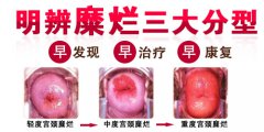 宫颈糜烂三度夫妻性生活疼吗?【看完就明白了】