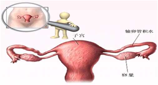 子宫内有积液是怎么回事？警惕子宫积液3个严重危害！