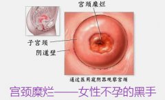 【宫颈糜烂的症状】_导致宫颈糜烂的4大因素！