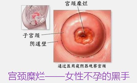 【宫颈糜烂的症状】_导致宫颈糜烂的4大因素!