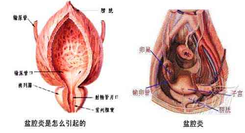 盆腔积液是怎么引起的?4个盆腔积液的日常护理妙招!
