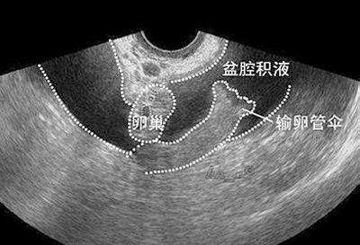 淮安盆腔积液治疗哪家医院好?三种治疗方法随你选