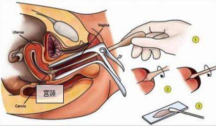 导致女性患阴道肿瘤的原因